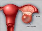 Gaz intestinaux de glucides complexes ou intolrance au lactose