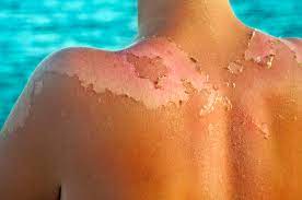 This can help ease the pain of your sunburn and stop your skin from peeling further. Sunburn Peeling How To Stop Sunburn Peeling Fast And Safely