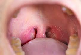 Image result for Uvulitis