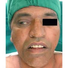 The soft palate is suspended from the skull base by the paired tensor...