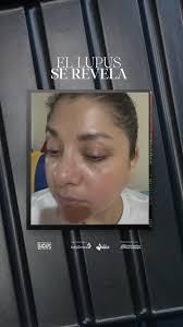 #ellupusserevela #ElLupusSeRevela #nodejesqueellupusgane Campaña de  concientización del lupus, esta soy yo al natural, sin filtro y sin  maquillaje, muestro el paño, en ocasiones he perdido las ...