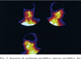 Diagnostico de muerte cefálica por el dr. Medicina Nuclear Y Diagnostico De Muerte Encefalica Angiogammagrafia Cerebral Con Tc99m Hmpao Sensibilidad Y Especificidad Diagnostica Semantic Scholar