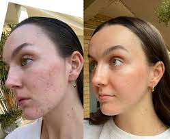 Sensitive dry skin skincare routine for results