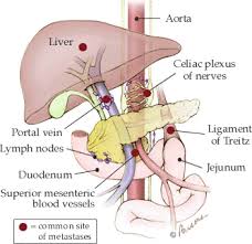 Pancreatic metastases can arise in any organ site but are mostly detected in abdominal sites. Metastasis