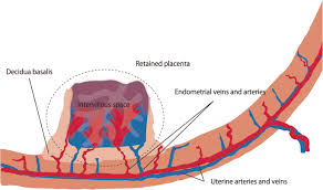 Image result for Retained Placenta