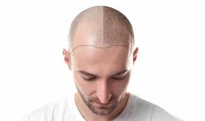 افضل مركز زراعة الشعر تركيا تكاليف اسطنبول roomsfinder