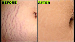 Properly hydrated skin is softer and more supple, causing your skin to appear more toned and eliminating some of the bumpy qualities of stretch marks. How To Get Rid Of Stretch Marks Fast In Few Days Post Pregnancy Diy At Home 100 Effective Youtube