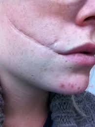 Изучайте релизы glasgow smile на discogs. H S Scar Face Glasgow Smile Bruises Scar