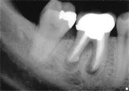 You have to piece together symptoms: Signs Of A Dead Non Vital Tooth St Lawrence Dentistry