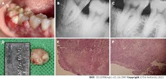 Image result for granuloma gum disease