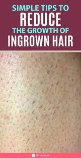 How To Get Rid Of Ingrown Hair Face Bikini Area Legs Arms