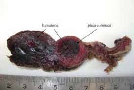 Trombohematoma Subcorionico Masivo Una Patologia Placentaria Emergente