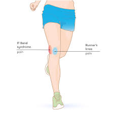 Runner's Knee:causes, Symptoms, And Treatment