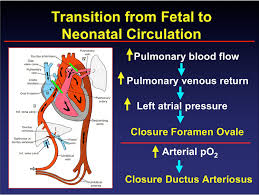 Image result for Delayed Transition from Fetal Circulation