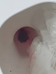 Tmi Ftm 39 Weeks Did I Loose My Mucus Plug Gross Pic June 2017 Babies Forums What To Expect