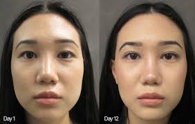 Máy Chăm Sóc Da Mặt Pebble Fleur 2 HOT & COLD + RF Professional Face L