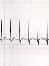 Pulsul variaza pe parcursul unei zile. Despre Tahicardie Tahicardia Este O Afectiune Cardiaca Foarte Complexa Care Imbraca Mai Multe Forme Si Care Poate Avea Efecte Grave Asupra Persoanelor Afectate In Cele Ce Urmeaza Vom Vedea Ce Reprezinta Palpitatiile