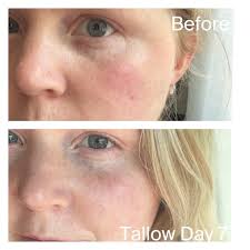 Reducing rosacea redness with skincare product