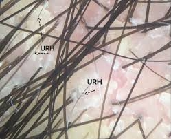 Seborrheic dermatitis is an inflammatory skin condition that causes an itchy, flaky rash. Is It Possible For Seb Derm To Cause Hair Loss Donovan Hair Clinic