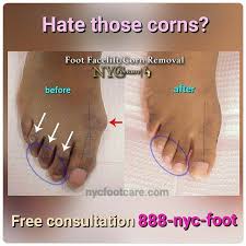 Realnycfootcare Corn Removal Corn On Toe Toe Corn Removal