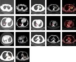 Because cancer cells often take up more glucose than healthy cells, the pictures can be used to find cancer in the body. A Large Scale Ct And Pet Ct Dataset For Lung Cancer Diagnosis Lung Pet Ct Dx The Cancer Imaging Archive Tcia Public Access Cancer Imaging Archive Wiki