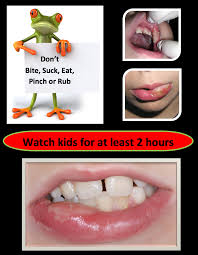 Dec 04, 2019 · use an ice pack or an ice cube wrapped in a cloth to numb the cut and help ease the pain, dr. Lip Biting After Treatment Texas Pediatric Dentistry