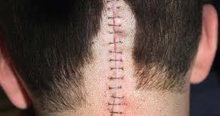 Diabetes mellitus, often just called diabetes, is not associated with having a brain tumour. Adjusting To Life After Surviving A Brain Tumor