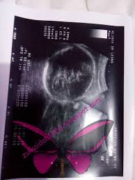 Walaupun baby kurang gerak pada akhir kehamilan adalah normal, tetapi harus diberi lebih setiap hari oncall, sudah biasa dengan ibu2 mengandung datang mengadu baby kurang gerak. Kisukisuka Idahku Baby Kurang Gerak