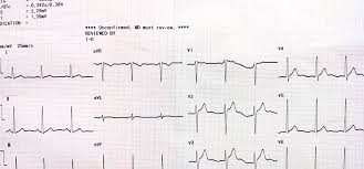 Image result for Electrocardiogram