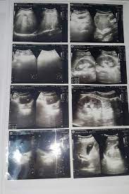 Maybe you would like to learn more about one of these? Mengobati Batu Ginjal Tanpa Operasi
