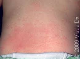 Image result for sweat rash on back baby