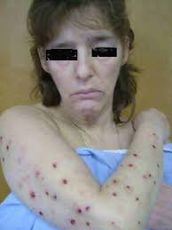 Image result for Neurotic Excoriation