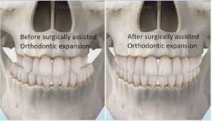Sideways Expansion In Orthodontics Clonmel Orthodontics