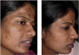 Dealing with dark spots on your face and/or body? Skin Of Color Skin Discoloration Seattle Washington Advanced Dermatology And Laser Institute Of Seattle