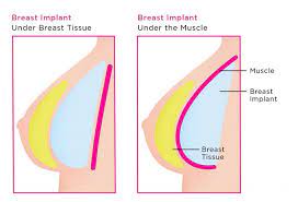 Breast implants melbourne & brisbane. Breast Implant Types Best Size Texture Shape And Pacement For You