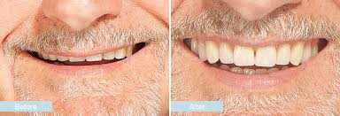 The pressure from your denture will help to reduce bleeding and swelling. Dentures Before And After Photos Denture Case Studies Changing Faces Denture Clinics