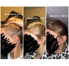 Learn microneedling online become a professional microneedling therapist or simply learn how to perform microneedling. Posting To Show That The Minox Dread Shed Is Worth It More In Comments Femalehairloss