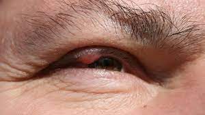 Hagelkorn Am Auge Ursachen Symptome Und Behandlung