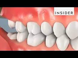 If your procedure is looking like it may be in a. Wisdom Tooth Removal Auckland Wisdom Teeth Extraction Maxcare Dental