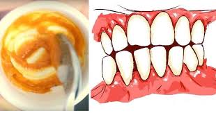 This Homemade Toothpaste Reverses Gum Disease And Whitens Teeth Healthy Food House Coconut Oil Toothpaste Recipe Homemade Toothpaste Gum Health