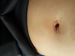 Bolit Pupok Posle Laparoskopii Hochu Rebenka