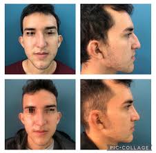 Resultados Pos-Quirúrgico👃🏻inmediato/definitivo Rinoseptoplastia  ultrasónica! Mínima inflamación y cero moretones posquirúrgicos🤕! No uso  de tapones nasales! Paciente con piel delgada, importante giba,  laterorrinia y punta caída! Resultado ...