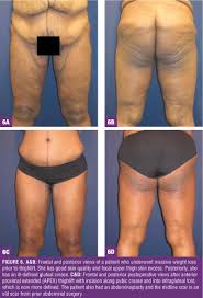 The other scars, after many years, may become inconspicuous as well and only identified by relatively dark skin at the sites. Limited Incision Bodylift From Head To Toe For The Massive Weight Loss Patient Bariatric Times