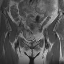 Postoperative Outcomes In 13 Patients With Diagnosis Of Mobile Cecum... |  Download Scientific Diagram