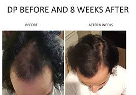 5.5 4 months after using biotin for hair growth. Amazon Com Spare My Hair Vitamins Vegan Hair Growth Supplement With Biotin Vitamins For Healthy Hair Treatment For Men Women Visible Results In 1 Month Longer Stronger Hair Gluten Free