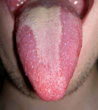 Image result for Fissured tongue