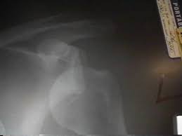 Image result for Rotator Cuff Triad Test