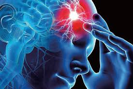 A isquemia cerebral ou avc isquêmico acontece quando há diminuição ou ausência de fluxo sanguíneo para o cérebro, diminuindo assim a quantidade de oxigênio que chega ao órgão e. Isquemia Cerebral Aguda Una Amenaza Creciente