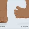 There are different causes for clubfoot depending on what classification it is given. 1