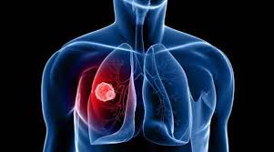Some of these early signs and symptoms include: How Lung Cancer Can Be Stopped From Spreading Lifestyle News The Indian Express
